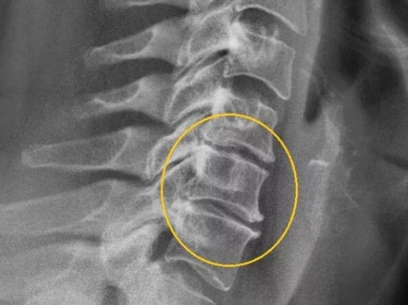A méhnyak gerincének osteochondrosis egy x -seriségen