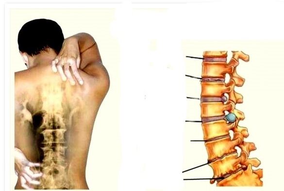 Az osteochondrosis a hátfájás oka